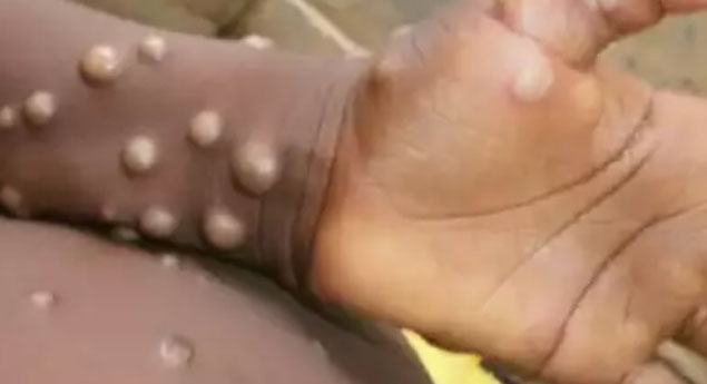 Monkeypox: ఆందోళన అక్కరలేదు: Dr Gilada