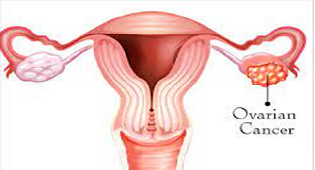 Ovarian cancer: 30 ఏళ్లు దాటాకా పిల్లలు పుట్టారా.. బరువు పెరిగారా... అండాశయ కేన్సర్ లక్షణాలు కారణాలు..!