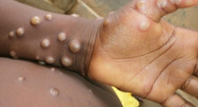 Monkeypox Death: లాస్ఏంజెల్స్‌లో మొట్టమొదటి మంకీపాక్స్ మృతి కేసు