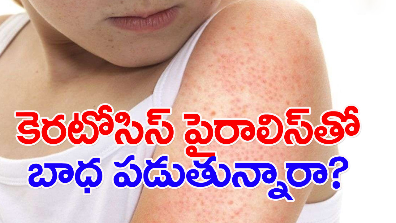 Keratosis pilaris : ఈ వ్యాధితో బాధపడుతున్నారా? దీనికి ఎలాంటి చికిత్సలు తీసుకోవాలంటే..!