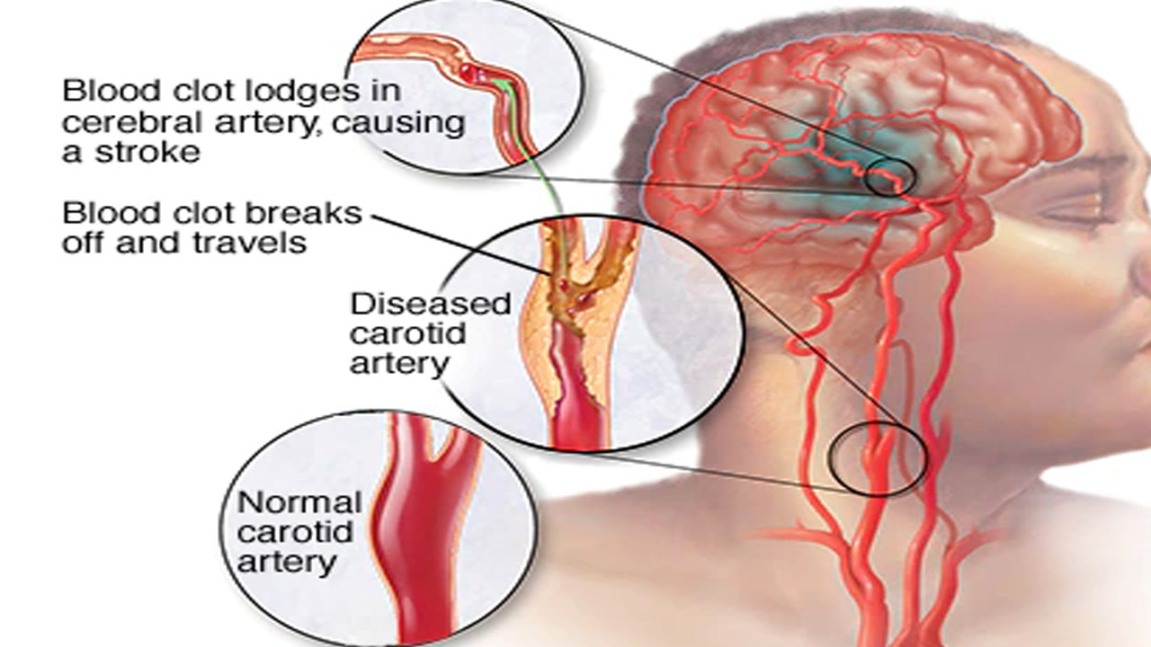 Brain stroke signs, symptoms: బ్రెయిన్ స్ట్రోక్ సంకేతాలు, లక్షణాలను ఎలా గుర్తించాలి.