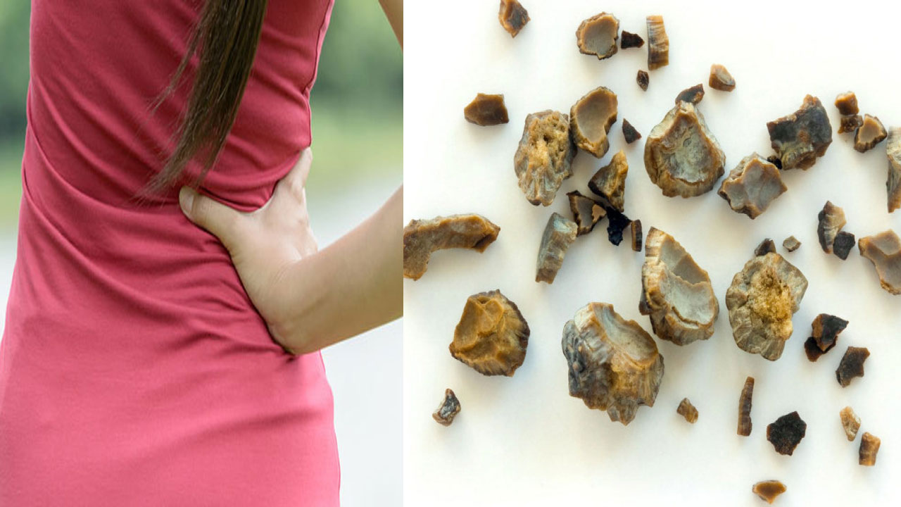 Kidney Stones vs Gallbladder Stones: కిడ్నీలో రాళ్లే కాదు ఇవి కూడా డేంజరే.. లక్షణాలు ఏంటంటే..