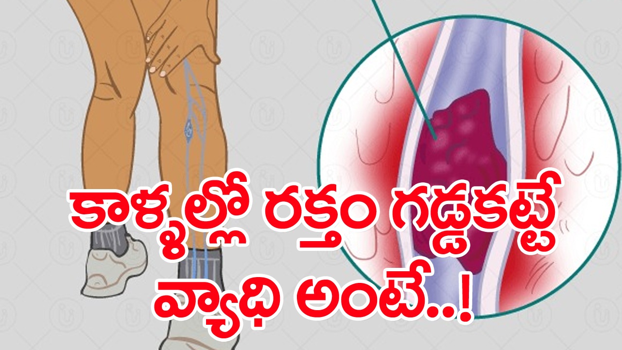Blood Clots: రక్తం గడ్డకడితే ప్రాణం పోయే ప్రమాదం కూడా ఉంది.. అలా జరగకుండా ఉండాలంటే..