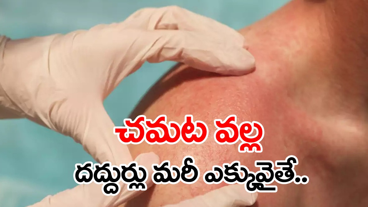 Summer: వేసవిలో దద్దుర్లు పోవాలంటే.. ఇలా చేసి చూడండి..!