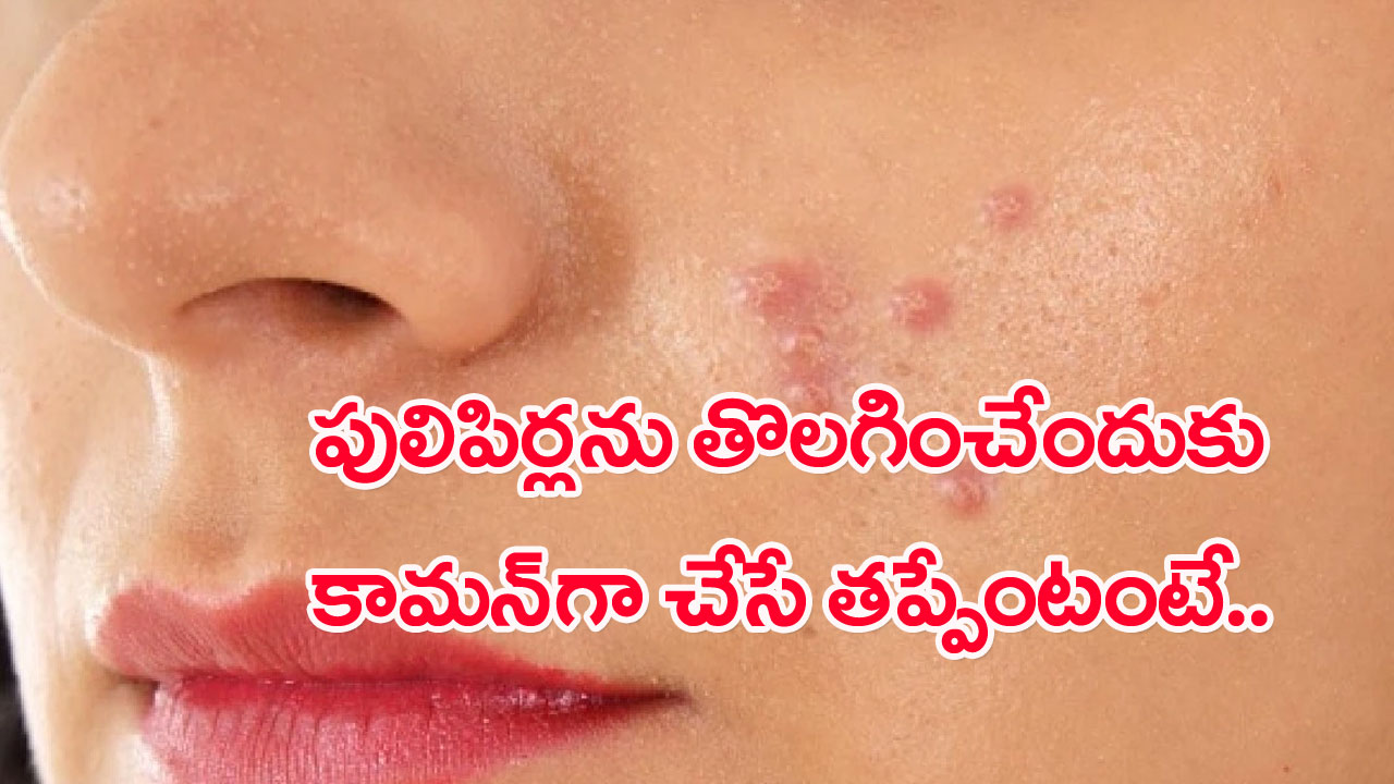 Warts on Face: ముఖంపై పులిపిర్లు ఎందుకొస్తాయి..? అసలు మొటిమలకు పులిపిర్లకు సంబంధమేంటో తెలుసా..?