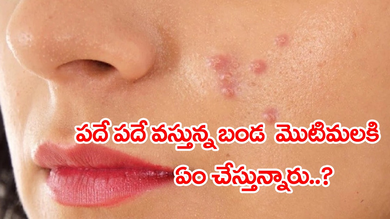 Skincare: మీ ముఖంపై ‘బ్లైండ్ పింపుల్స్’ను గుర్తించారా?.. ఈ ఈజీ టిప్స్‌తో వాటికి ఇలా గుడ్‌బై చెప్పేయండి.. 