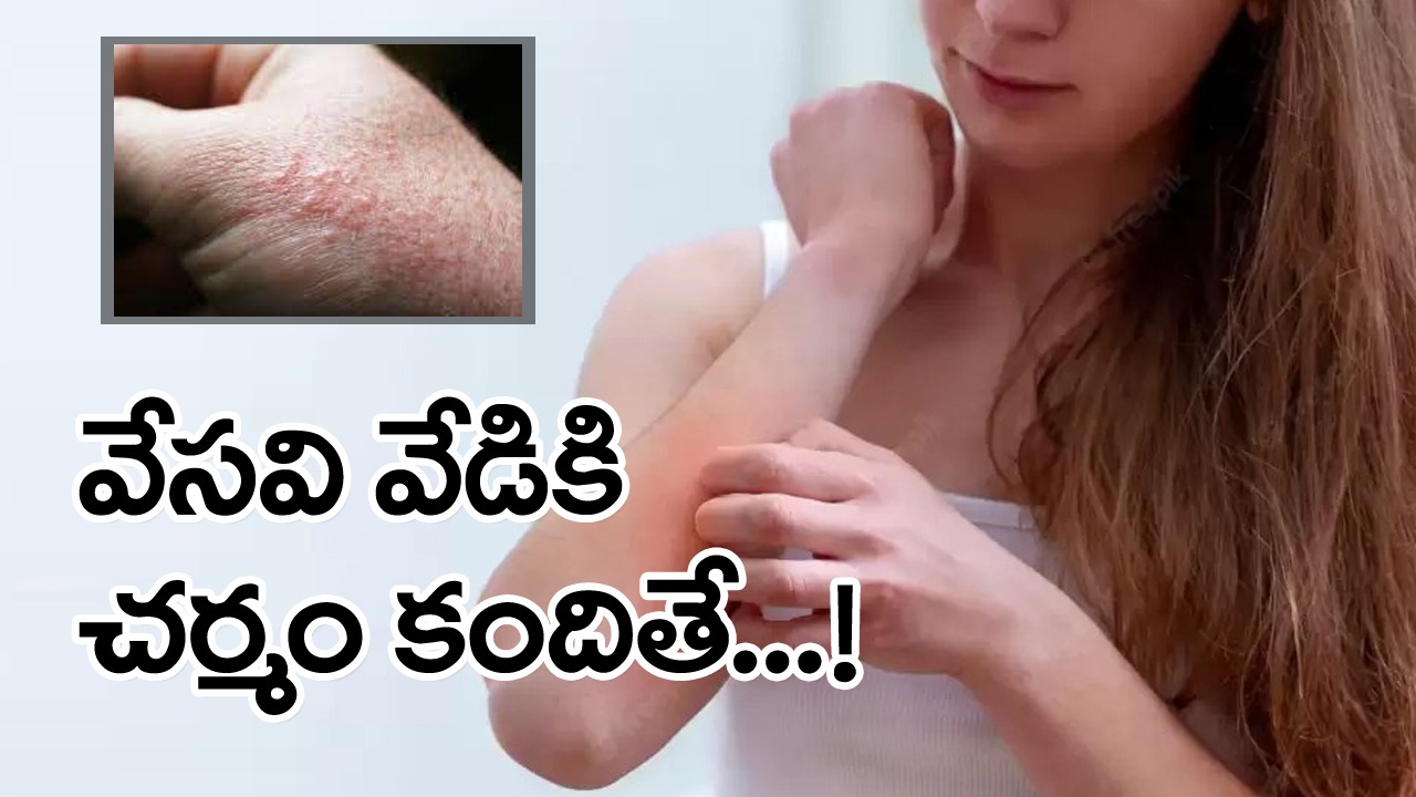Sun Burn: ఎండ వేడికి ఒళ్లు పేలిపోతుందని చల్లబరుచుకోవడానికి ఈ ఐదు మాత్రం అస్సలు చేయకండి..!