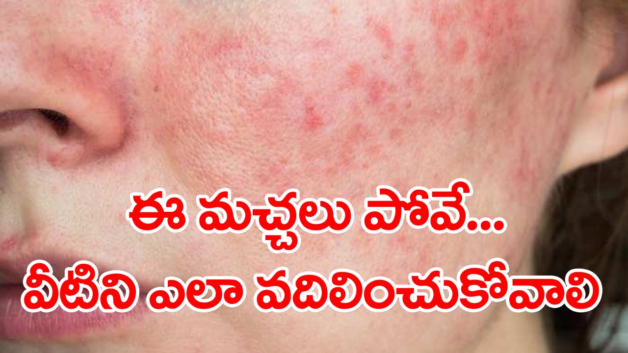 Skin Health: మొటిమలు తగ్గినా.. ఆ మచ్చలు పోవడం అంత ఈజీ కాదండోయ్.. ఈ సింపుల్ చిట్కాలు పాటిస్తే..!  