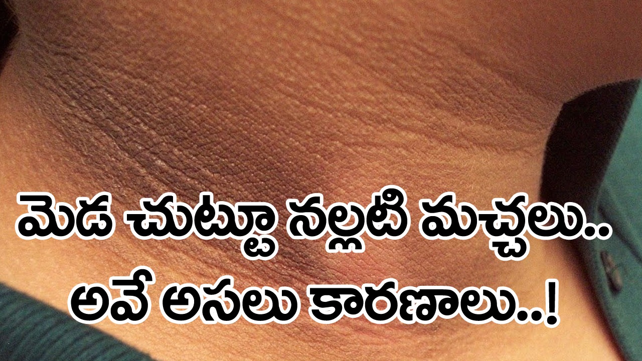 Dark Skin: మెడచుట్టూ నల్లగా మారిపోతోందా..? అలెర్జీ అనుకుంటే పొరపాటే.. అస్సలు ఆలస్యం చేయొద్దని డాక్టర్లు చెప్పడం వెనుక..!