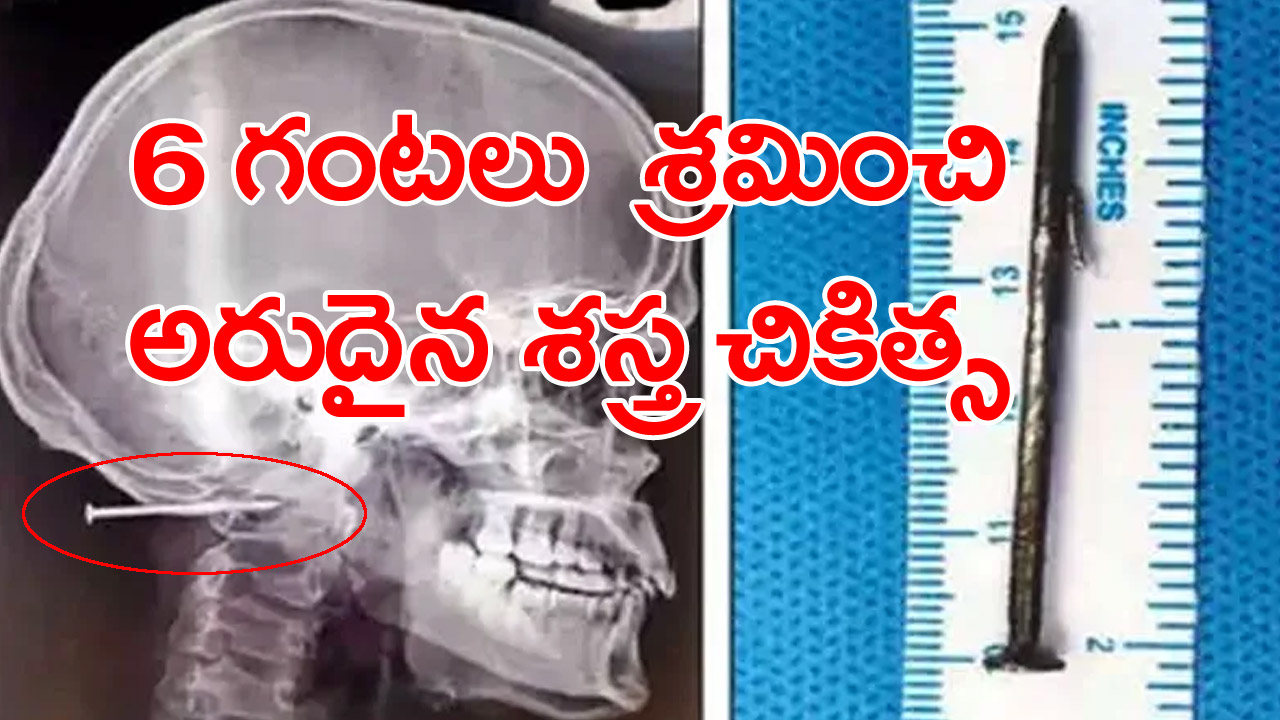 Rare Surgery : యువకునికి అరుదైన శస్త్ర చికిత్స.. తలలోకి దూసుకెళ్లిన రెండు అంగుళాల మేకు తొలగింపు..