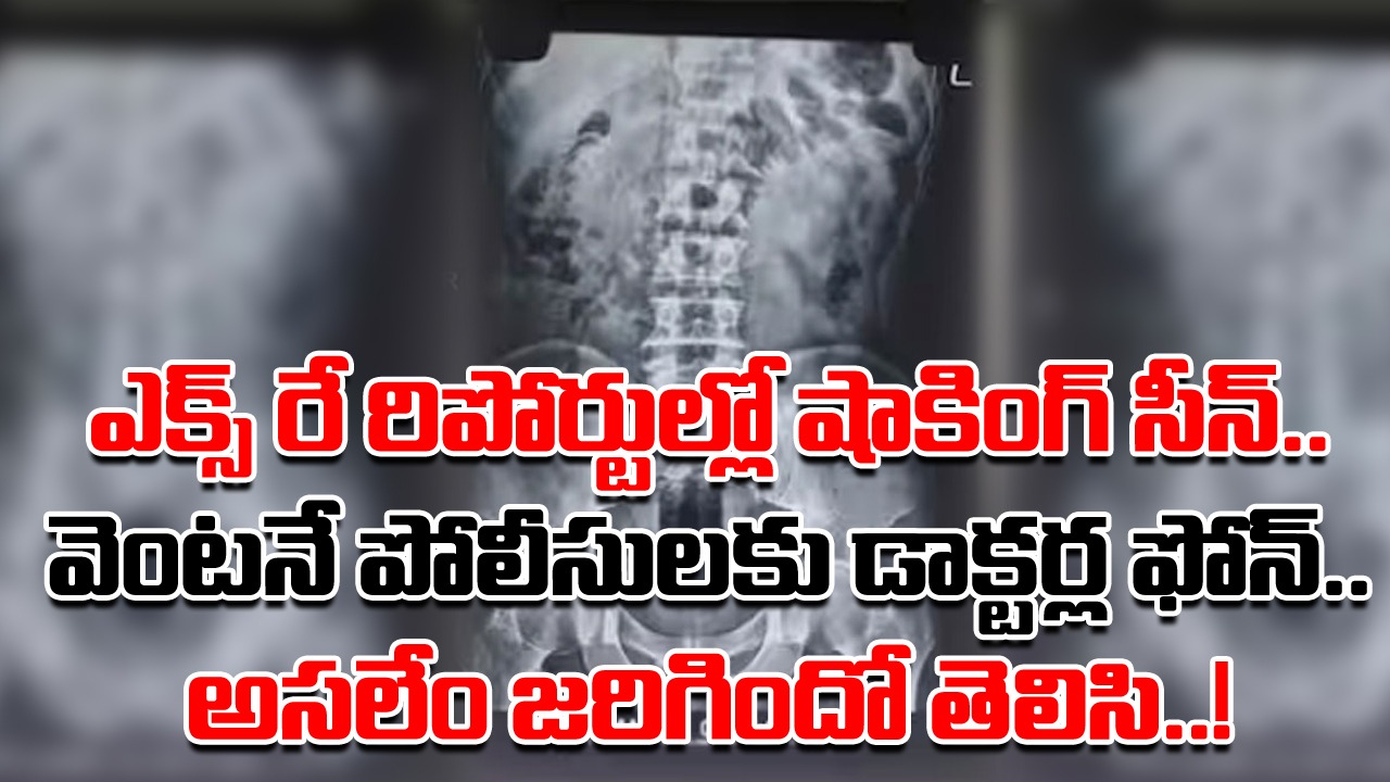 X-Ray Report: నడుము కింది భాగంలో భరించలేని నొప్పి.. ఎక్స్‌రే రిపోర్టులు చూసి నివ్వెరపోయిన డాక్టర్లు.. పోలీసుల ఎంట్రీతో..!