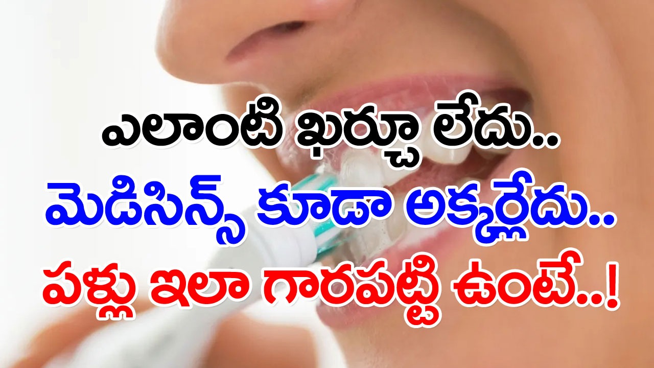 Tartar on Teeth: ఎన్నిసార్లు బ్రష్ చేసినా.. పళ్లు ఇలాగే ఉంటున్నాయా..? గారపట్టి అస్సలు పోవడం లేదా..? ఈ 6 చిట్కాలతో..!