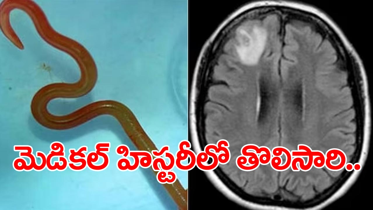 Live Parasitic Worm: ఇలా జరగడం ప్రపంచంలో తొలిసారి.. ఓ 64 ఏళ్ల మహిళ మెదడులో..