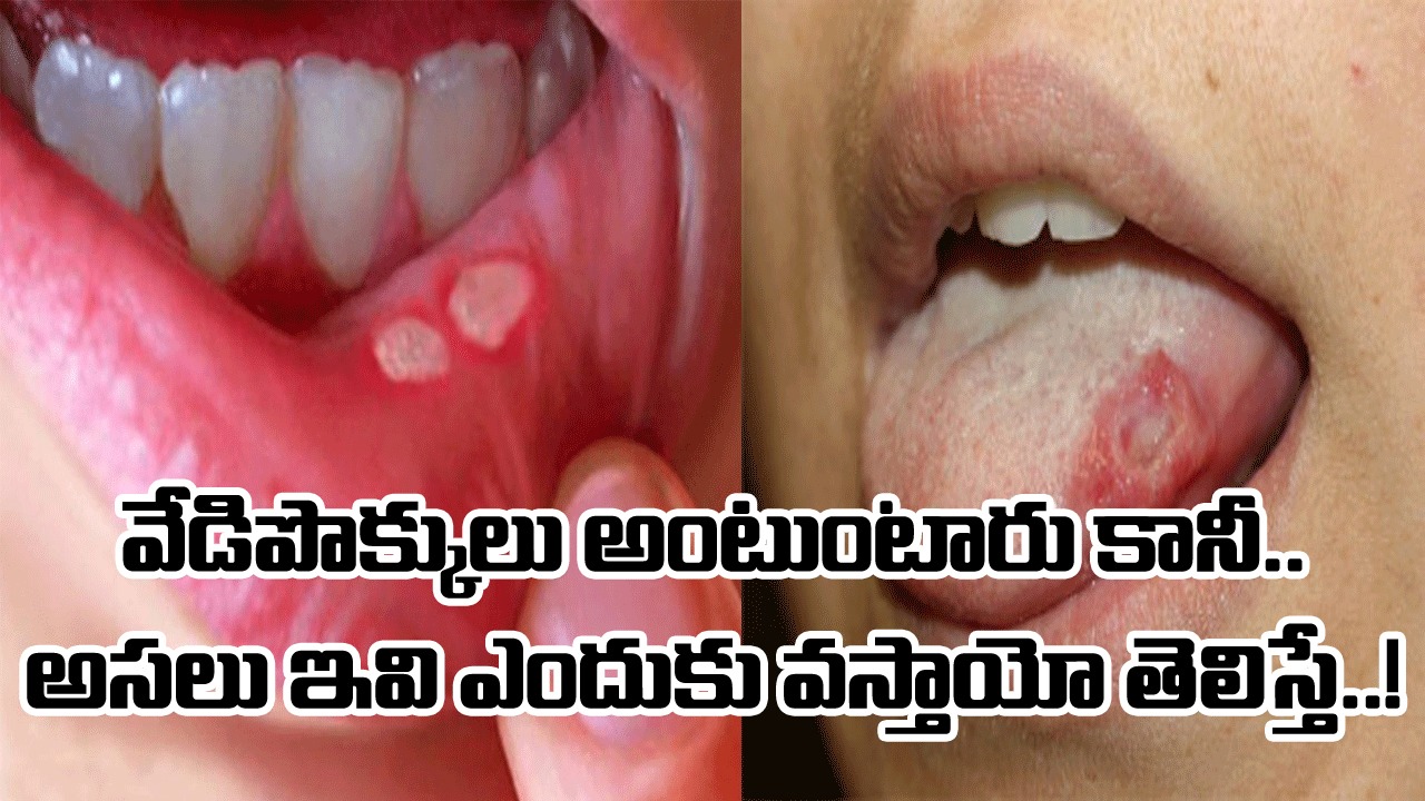 Health Tips: నోట్లో పెదాల కింద ఇలాంటి పొక్కులు వచ్చాయా..? అసలు ఇవెందుకు వస్తాయో తెలిస్తే..!