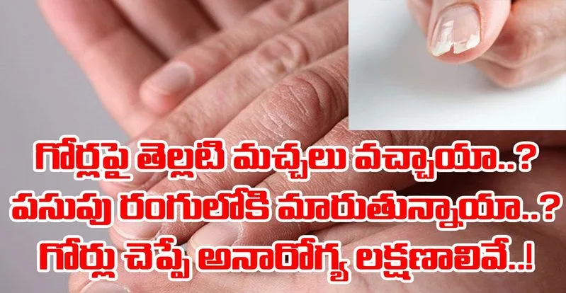 White Marks On Nails Indicates,చేతి గోళ్లపై ఈ మచ్చలుంటే అదృష్టం మీ వెంటే..!  - know what palmistry says about white spots on the nails will get fortune  - Samayam Telugu