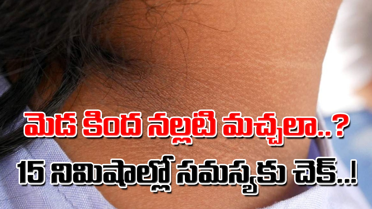 Dark Skin: కేవలం 15 నిమిషాల్లో సమస్యకు చెక్.. మెడ కింద నల్లగా మారిపోయిన చర్మాన్ని ఎలా మార్చేశారో మీరే చూడండి..!