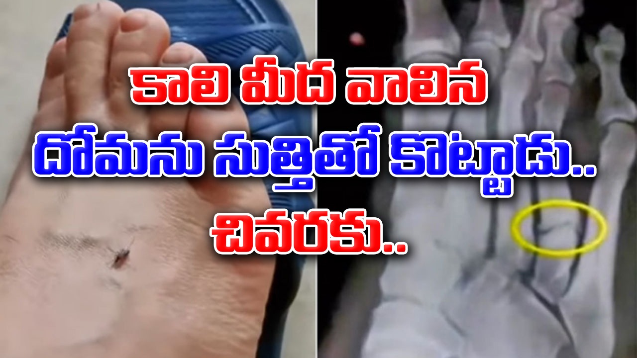 Funny Video: మరీ ఇంత అమాయకత్వమా? దోమ వాలితే సుత్తితో కొట్టాడు.. ఎముక విరిగి ఆస్పత్రిలో చేరాడు..!