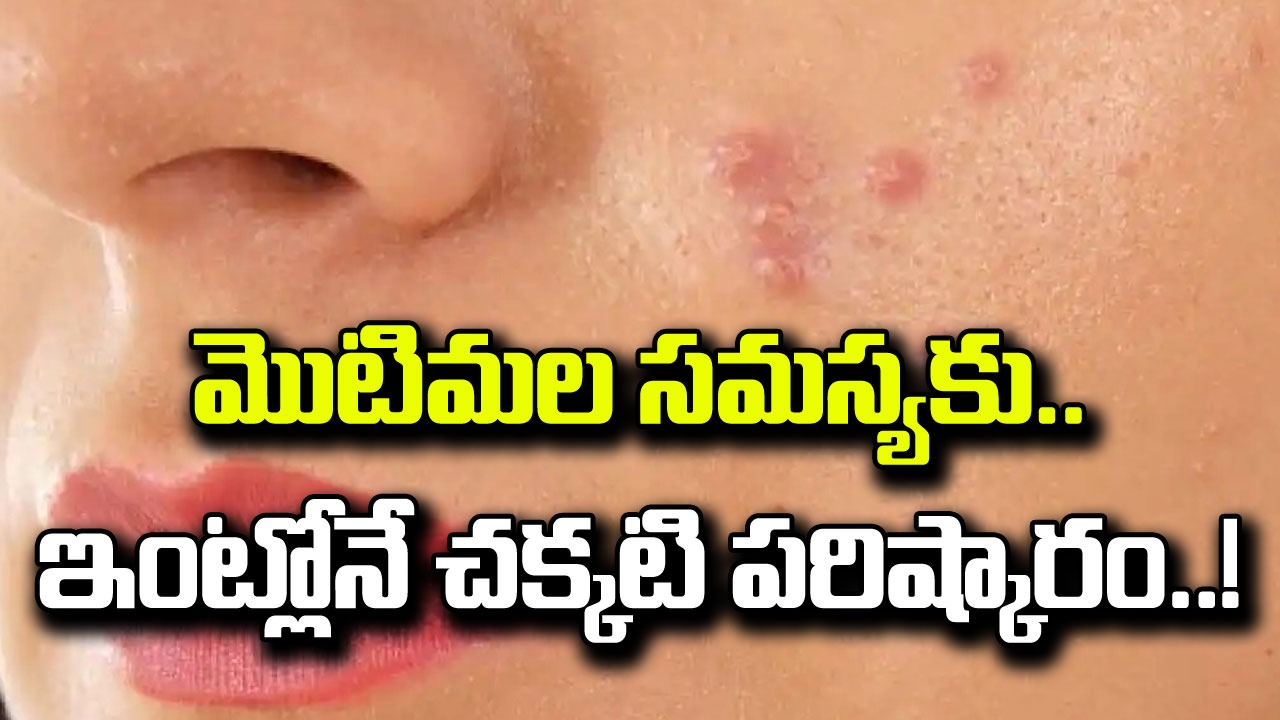 Pimples: ముఖంపై మొటిమలు వస్తున్నాయి కదా అని వాటినీ.. వీటినీ వాడకండి.. ఒక్కసారి ఇలా ట్రై చేసి చూస్తే..!