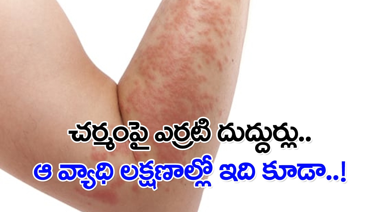 Skin Rash: చర్మంపై ఇలా ఎర్రటి దుద్దుర్లు ఎందుకొస్తాయ్..? ఆ వ్యాధికి ముందస్తు సూచన ఇదేనా..?