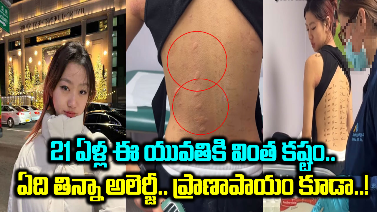 Viral Video: పాపం.. 21 ఏళ్ల ఈ యువతికి ప్రతిరోజూ నరకమే.. ఏది తిన్నా అలెర్జీ.. ఈమె ట్రీట్మెంట్ వీడియోను చూస్తే..!