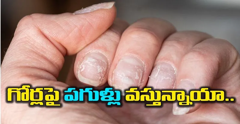 Nails: ఏ విటమిన్ లోపం వల్ల గోళ్లకు పసుపు రంగు వస్తుందో తెలుసా? | Know which  vitamin deficiency causes yellow nails