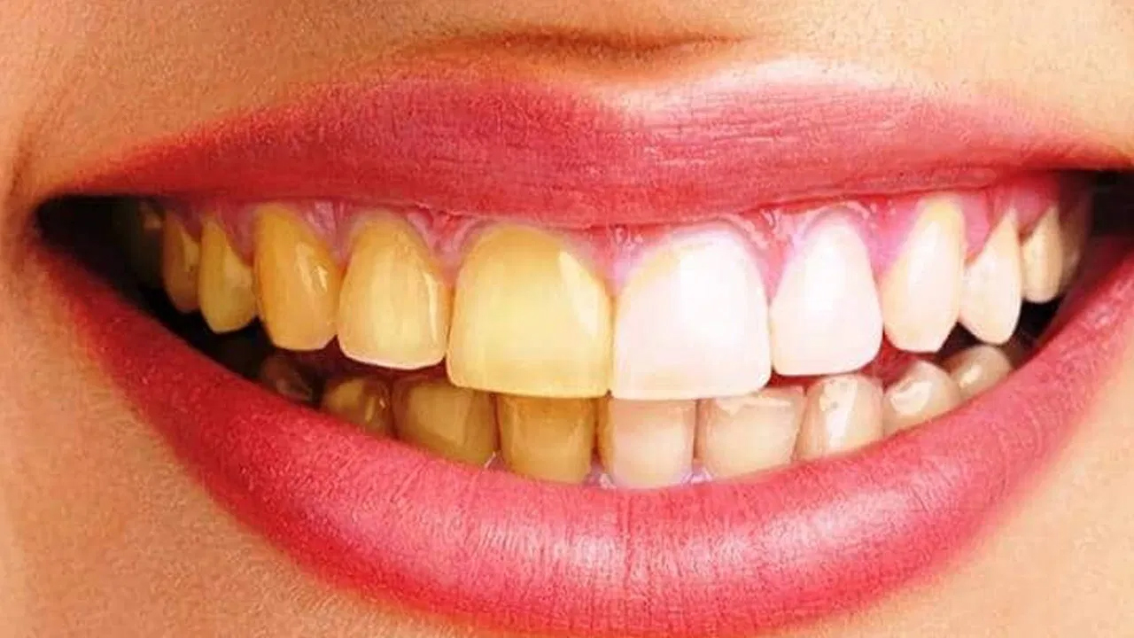 White Teeth: ఇలా చేశారంటే.. గారపట్టిన దంతాలు మిళమిళా మెరవాల్సిందే.. 
