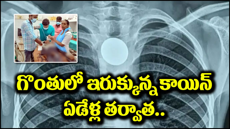 Viral News: ఐదేళ్ల వయసులో కాయిన్ మింగాడు.. కట్ చేస్తే ఏడేళ్ల తర్వాత..