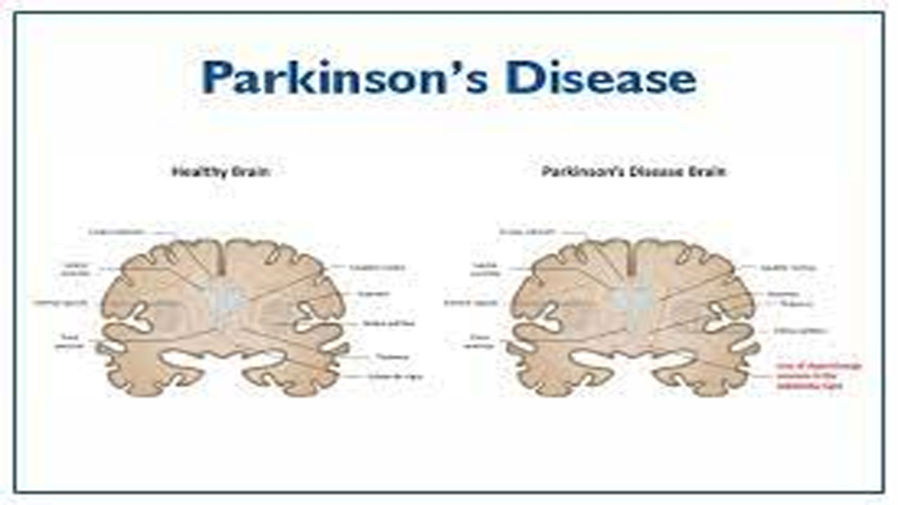 UK Scientists : పార్కిన్సన్స్‌ను ఏడేళ్ల ముందే గుర్తించే పరీక్ష