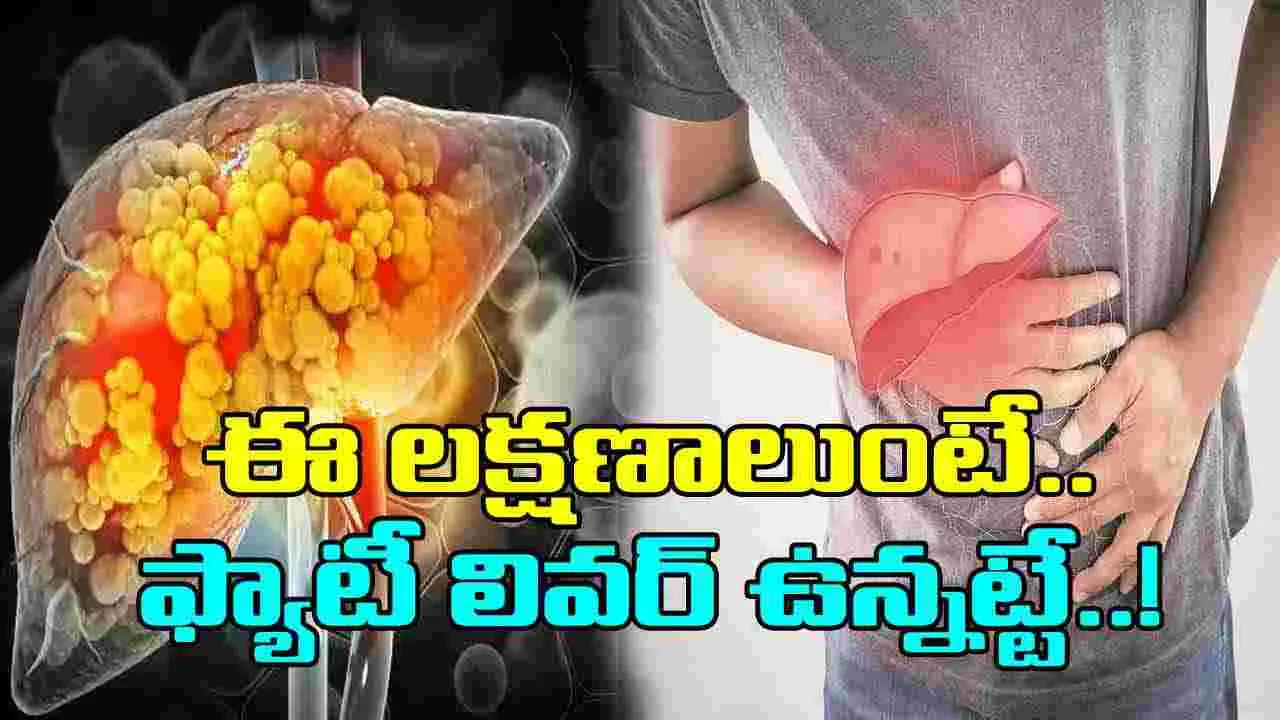 Fatty Liver: ఈ లక్షణాలు కనిపిస్తే ఫ్యాటీ లివర్ ఉన్నట్టే.. వెంటనే వైద్యుడిని కలవాల్సిందే..!