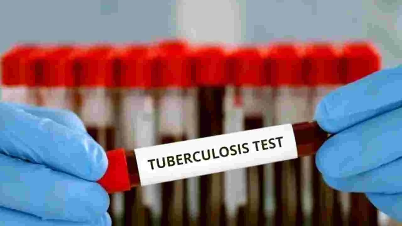 Tuberculosis : రూ.35కే క్షయ నిర్ధారణ పరీక్ష