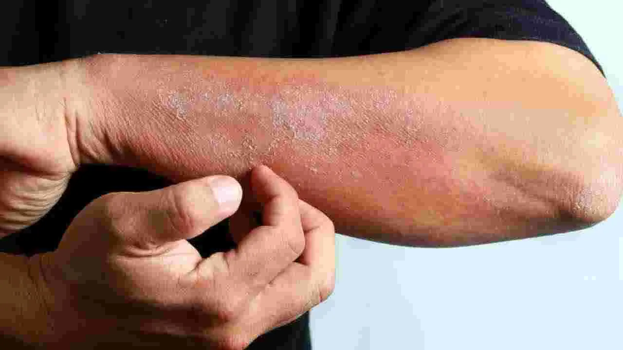 Skin Problems: వర్షాకాలంలో ఈ చర్మ సమస్యలు వస్తాయ్.. జాగ్రత్త 