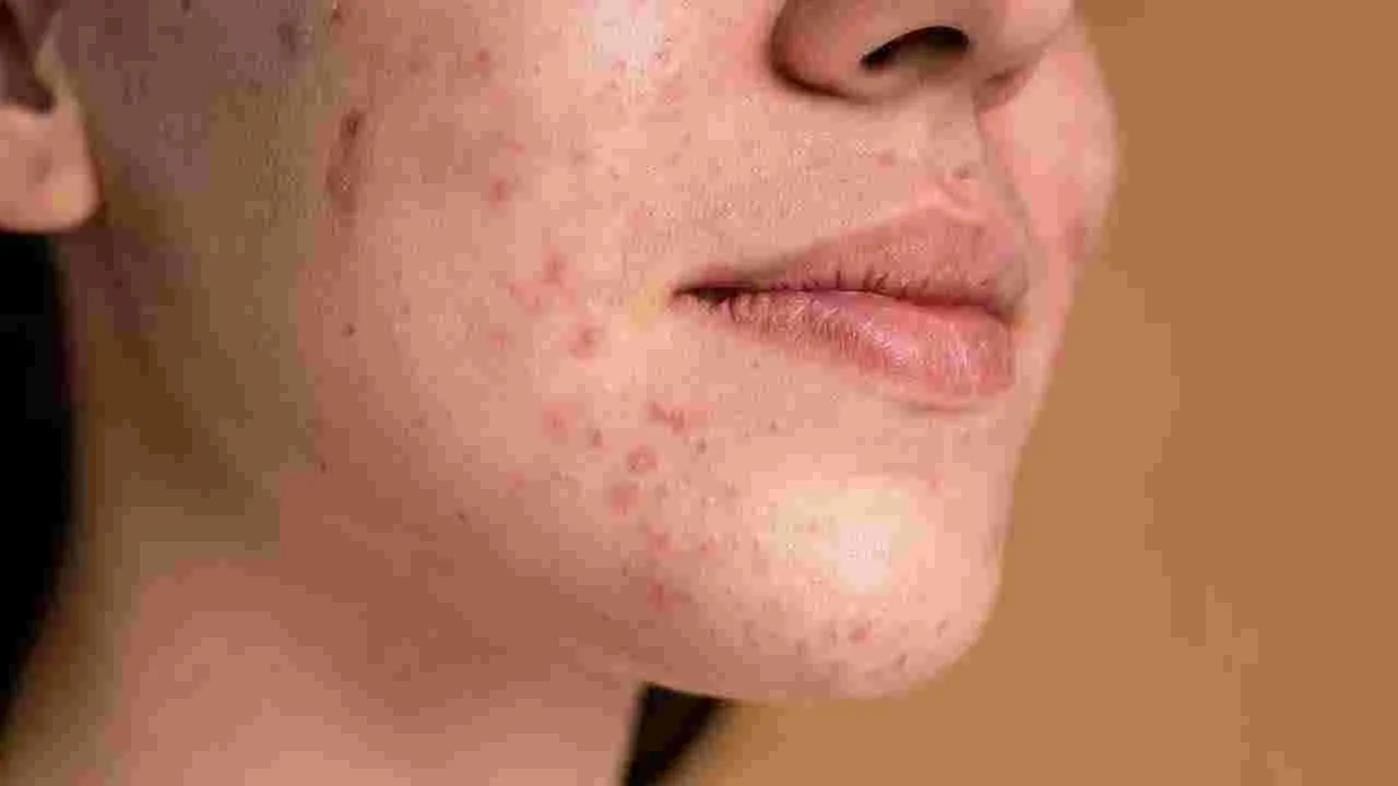 Pimple Marks: మీ ముఖం మీద మొటిమల తాలూకు మచ్చలు ఉన్నాయా?  ఇవి వాడి చూడండి..!