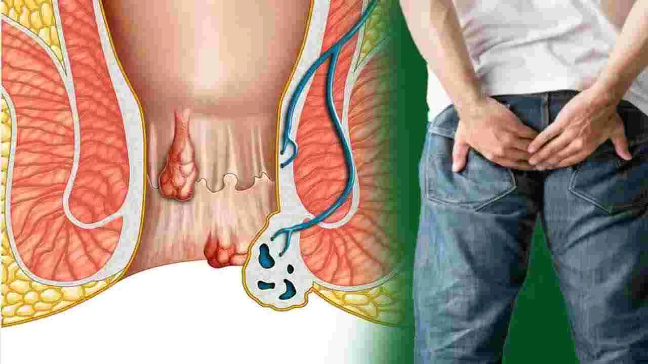 Health Tips:  పైల్స్ తో బాధపడుతున్నారా? ఆయుర్వేదం చెప్పిన ఈ టిప్స్ పాటిస్తే..!