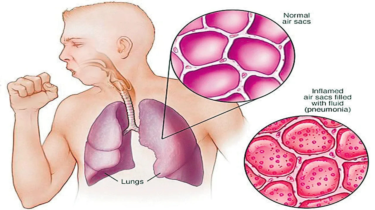 ఊపిరిని పట్టే న్యూమోనియా