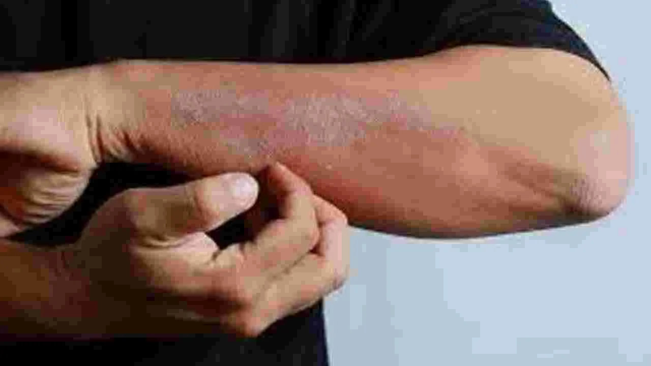 Psoriasis:  మీకు చర్మ సమస్యలున్నాయా.. ఈ లక్షణాలు కనిపిస్తే ఆ జబ్బు ఉన్నట్టే..