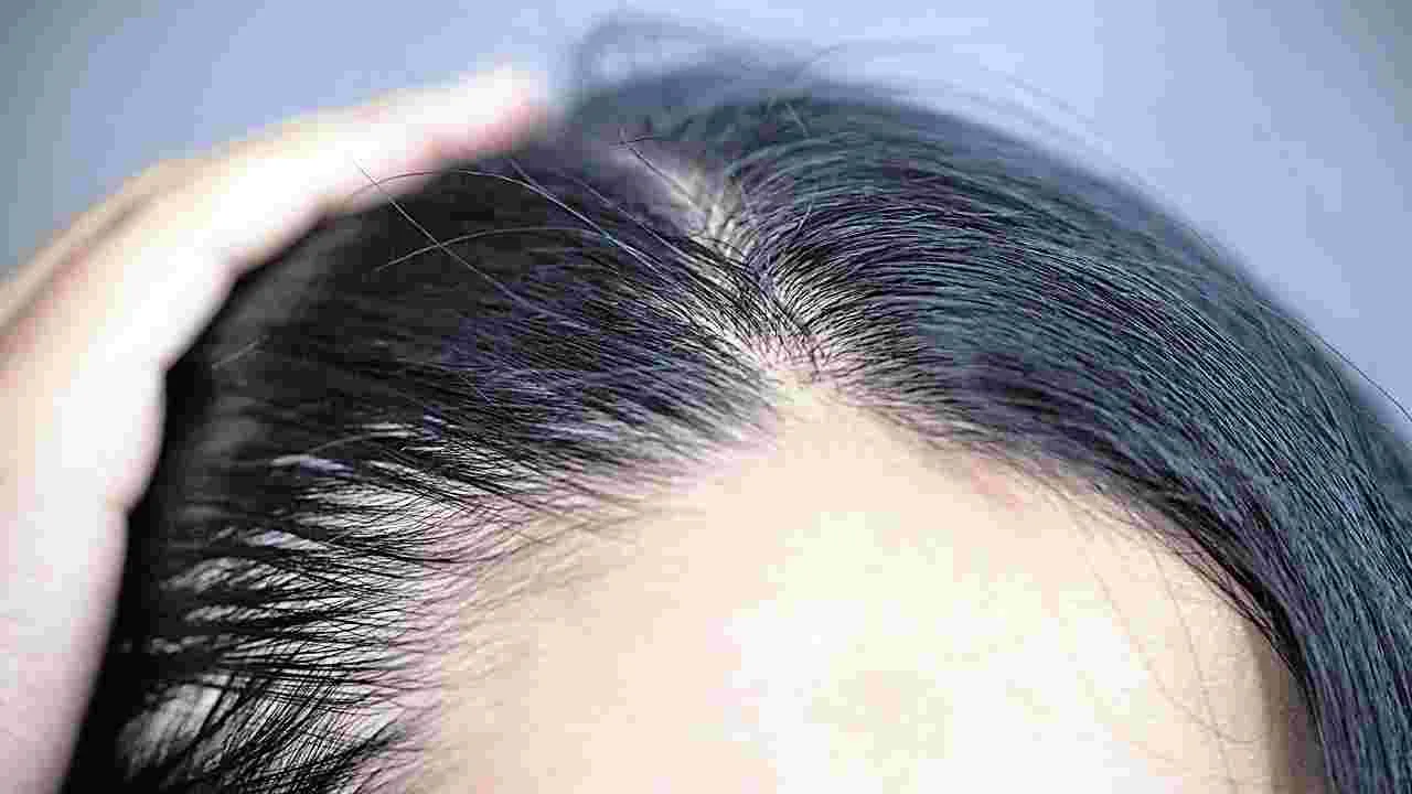 Hair Loss : మహిళల్లోనూ పెరుగుతున్న బట్టతల