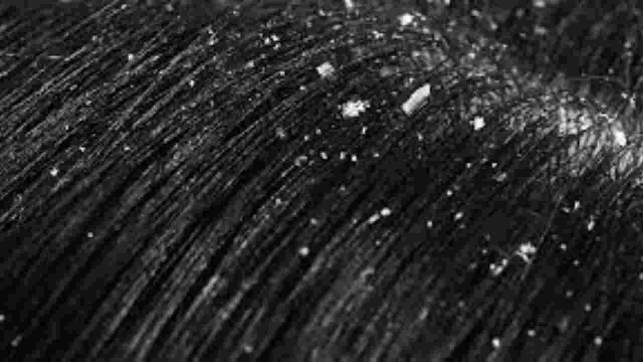 Dandruff: చుండ్రు సమస్య వేధిస్తోందా.. ఇలా క్లియర్ చేసుకోండి..