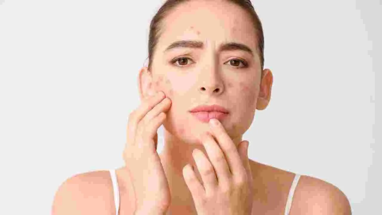 Pimples: ఈ అలవాట్లపై శ్రద్ధ పెట్టండి.. మొటిమలు అవే తగ్గిపోతాయి..