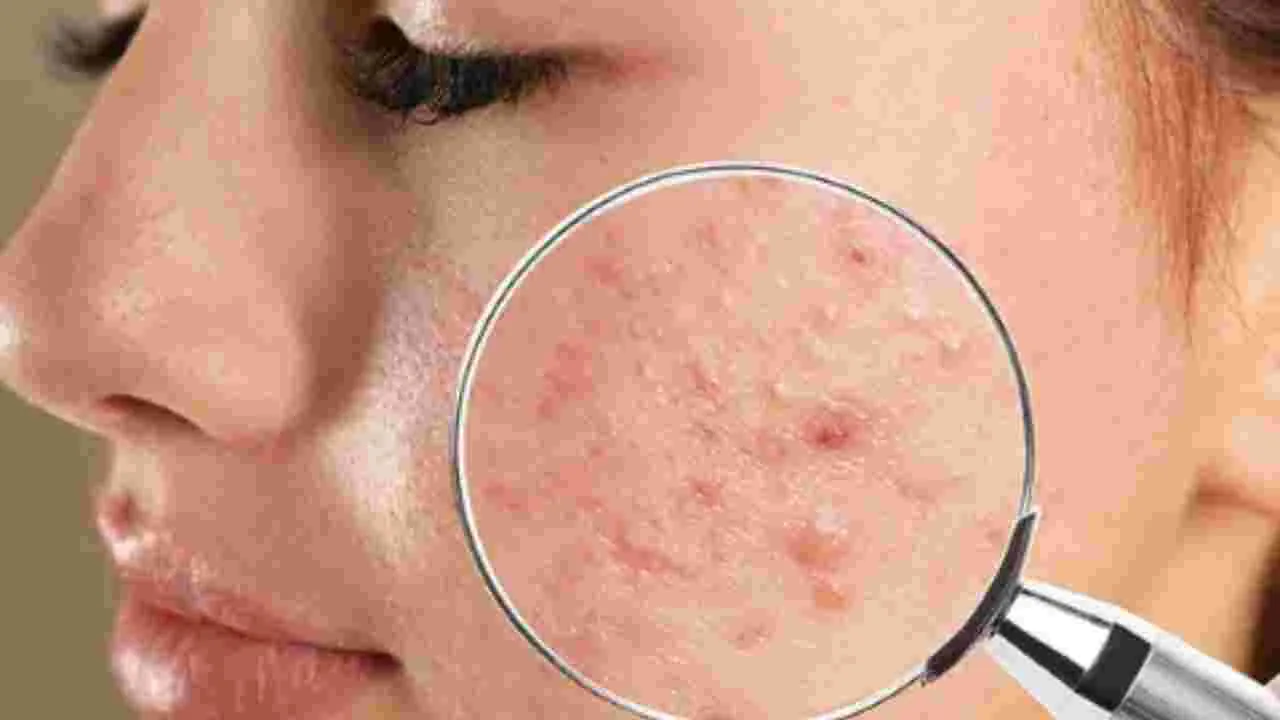 Pimples: మొటిమలు మిమ్మల్ని వేధిస్తున్నాయా.. ఇలా వదిలించుకోండి..