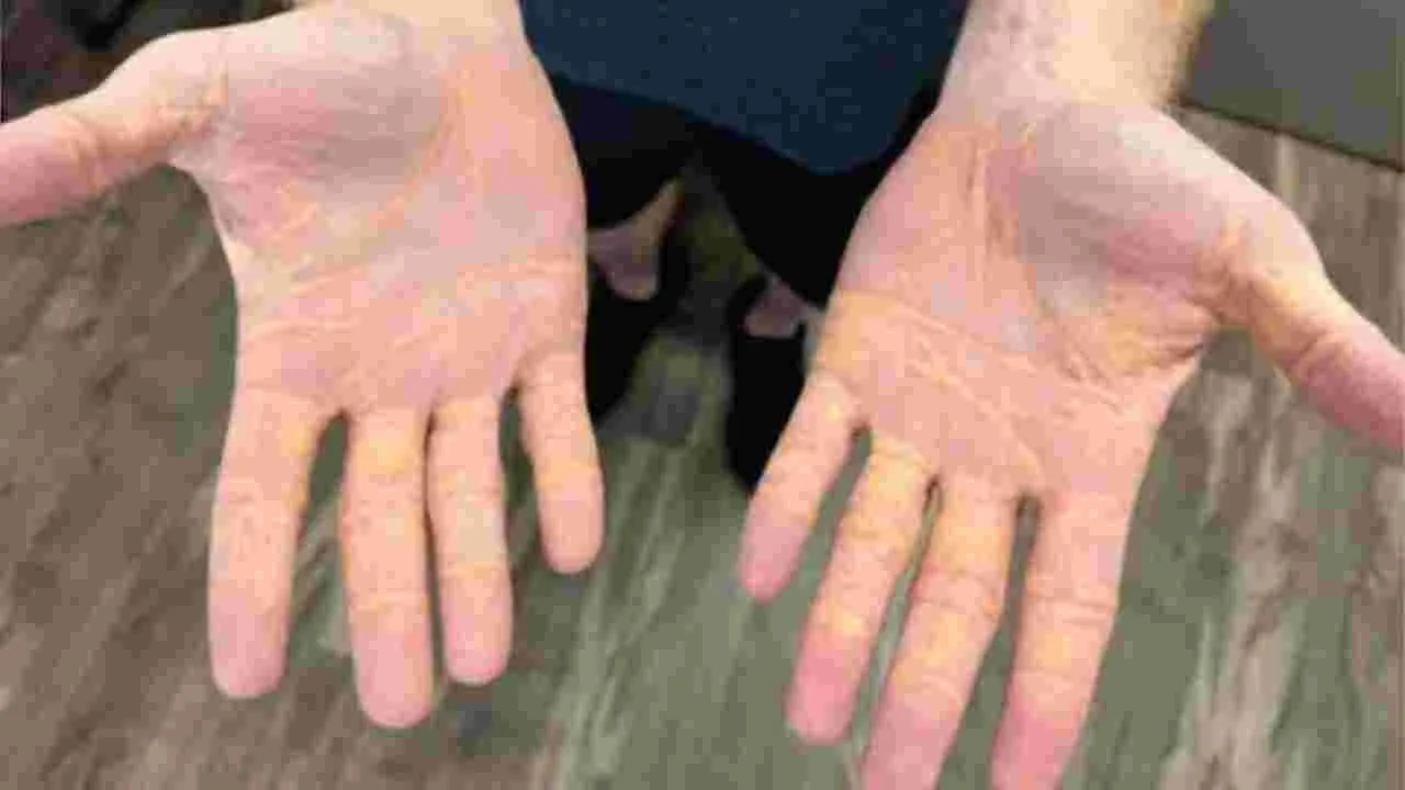 Man leaks Cholesterol: బాబోయ్ ఇదేం వింత వ్యాధి! వ్యక్తి చేతుల్లోంచి లీకైపోతున్న కొలెస్టెరాల్ 