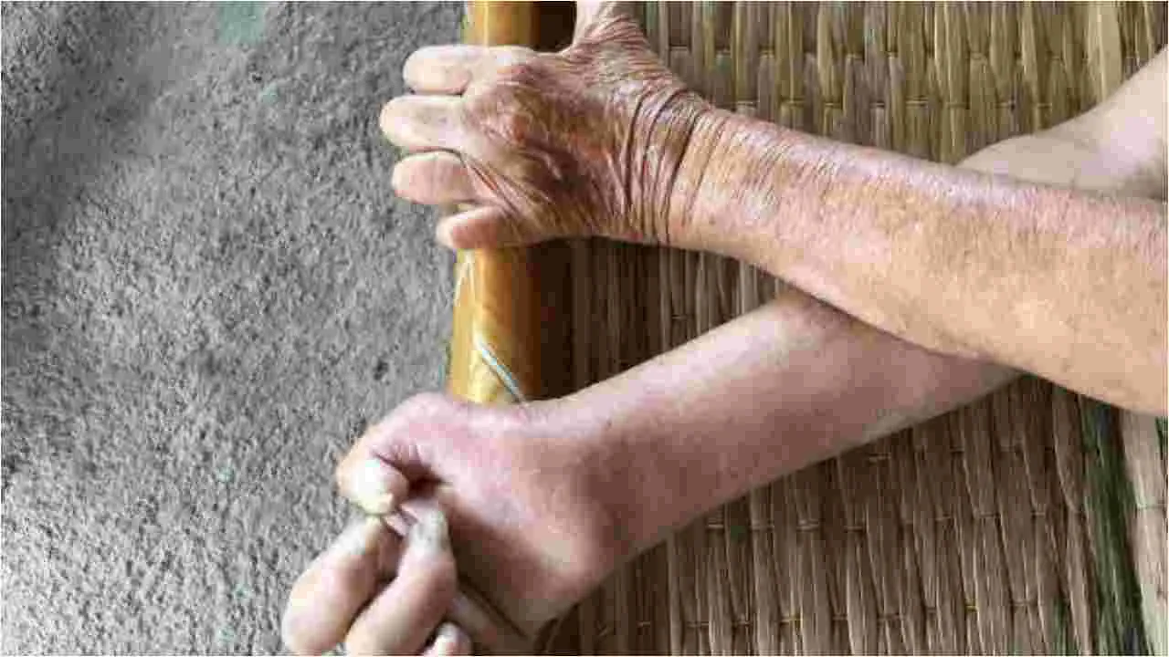 Leprosy: కుష్టు వ్యాధి ఎలా వ్యాపిస్తుందో మీకు తెలుసా..