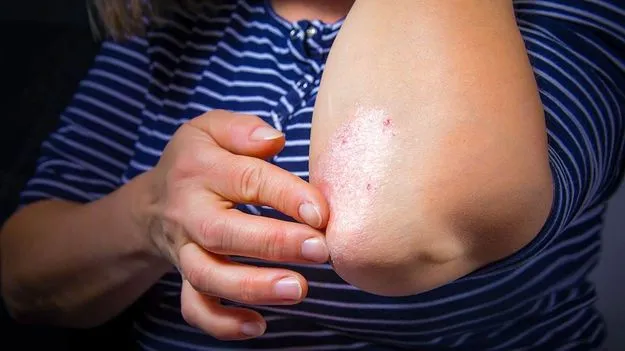 Psoriasis and Nutrition: ఈ తరహా ఫుడ్ తింటే సోరియాసిస్‌కు చెక్!