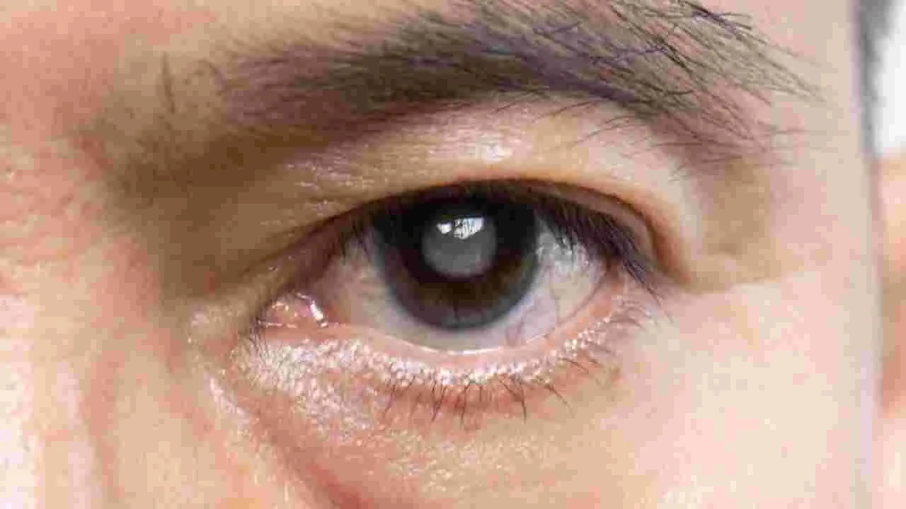 Glaucoma: ఒత్తిడితో కూడా గ్లకోమా ముప్పు! కొత్త అధ్యయనంలో వెల్లడి