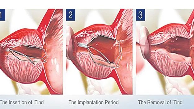 Hyderabad: పదేపదే మూత్రవిసర్జనకు ‘ఐటీఇండ్‌’తో చెక్‌