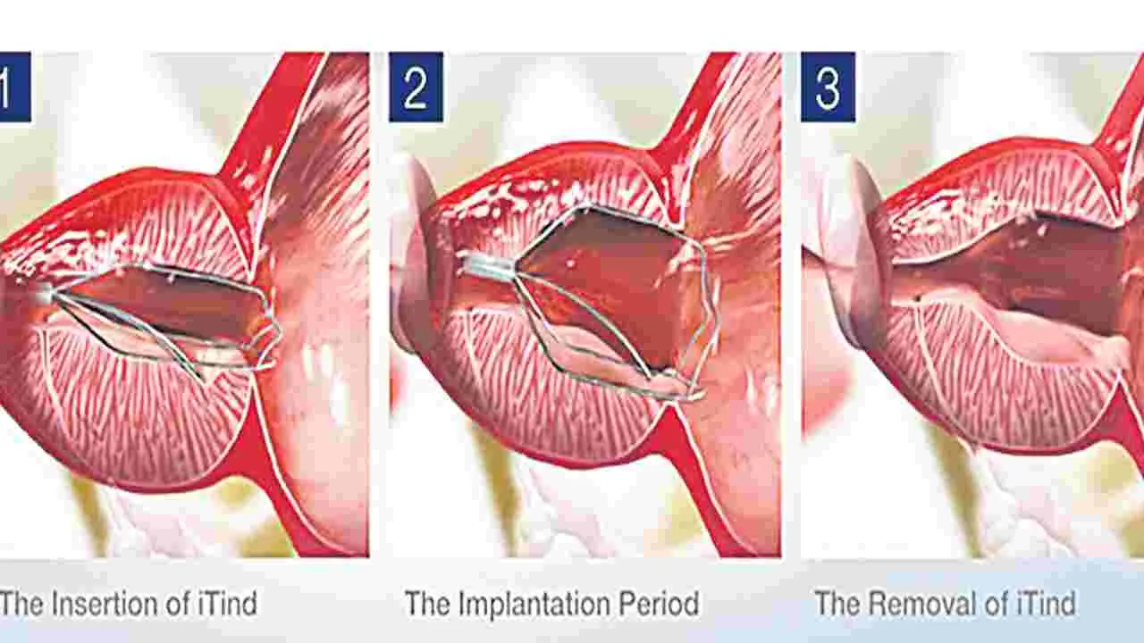 Hyderabad: పదేపదే మూత్రవిసర్జనకు ‘ఐటీఇండ్‌’తో చెక్‌