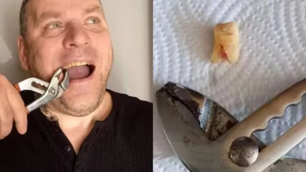 Man Pulls Out Own Tooth: భరించలేనంత పన్ను నొప్పి.. దొరకని డెంటిస్ట్ అపాయింట్మెంట్.. రోగి షాకింగ్ నిర్ణయం