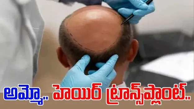 Hair Transplant: హెయిర్ ట్రాన్స్‌ప్లాంట్ చేయించుకున్న కొన్ని గంటలకే.. 
