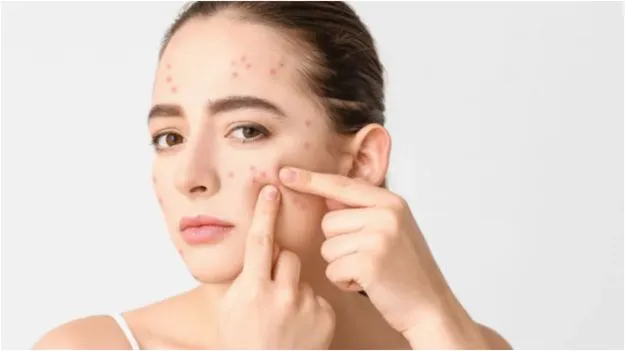 Pimples: ముఖంలోని వివిధ భాగాలలో మొటిమలు ఎందుకు వస్తాయి..