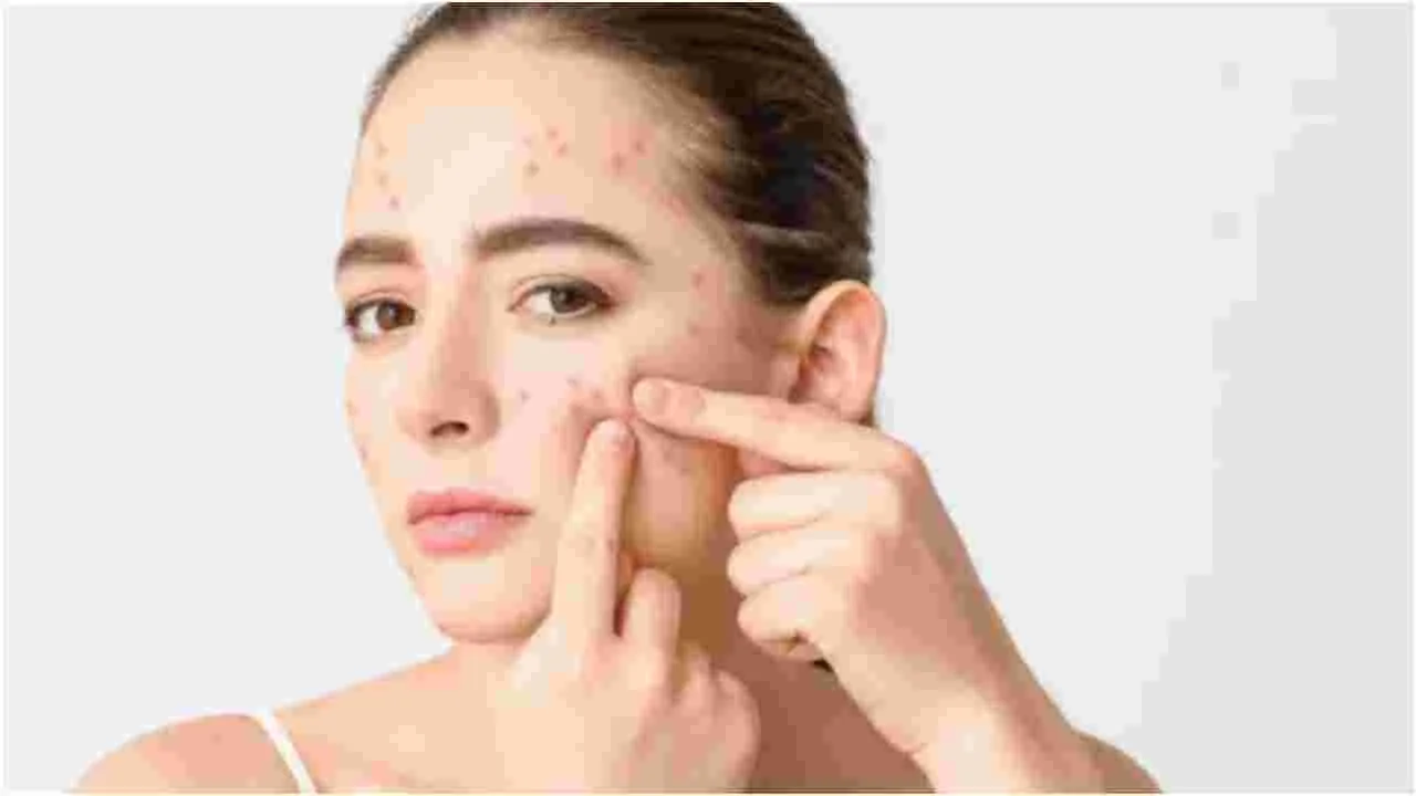 Pimples: ముఖంలోని వివిధ భాగాలలో మొటిమలు ఎందుకు వస్తాయి..