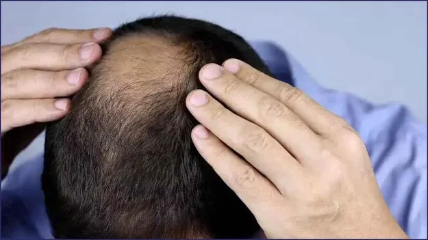 Baldness: పురుషులకే బట్టతల ఎక్కువగా రావడానికి సైంటిఫిక్ రీజన్స్ ఇవే..